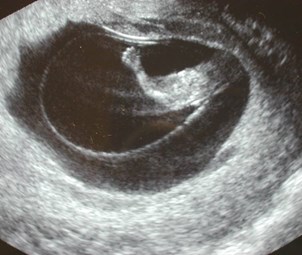 12 wk-1 IUP arm