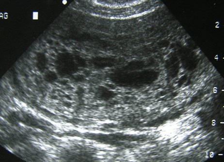 1st trimester mole-1