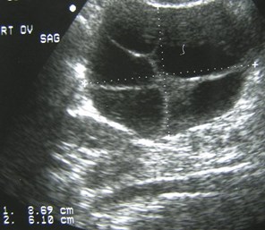 1st trimester mole theca cysts-4