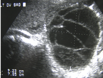 1st trimester mole theca