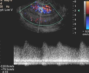 sag uterus-w doppler-3