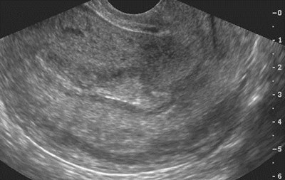 sag uterus-1