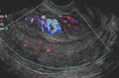 sag uterus-w color-2