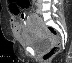 sag 4-10 infected hematoma