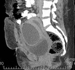 4-22 sag abscess