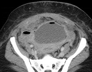 4-22 ax abscess, path w necrotic placenta, infection