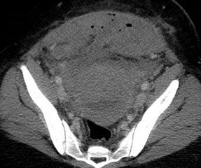 trv 4-10 infected hematoma