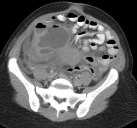 abscess