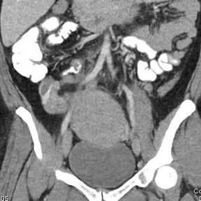 cor ROV thrombosis