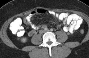 Rt ov w vein thrombosis, appy