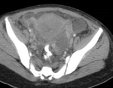 bilat thrombosed veins, CT