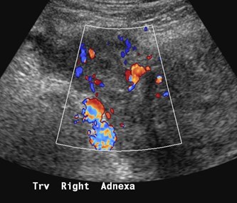 thrombosed R vein US