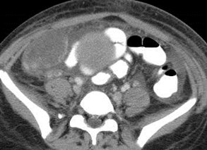 large ROV, thrombosed veins