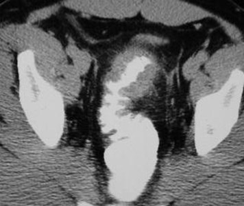 Sigmoid Diverticulitis-8