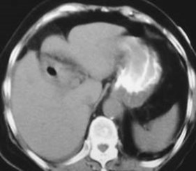 Gallstone Ileus-1