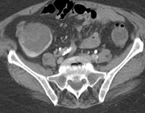 C:\Users\Ryan\Desktop\Desktop Data\Radiology\TEACHING FILES\Bowel\GI Bleed CT\CT\ser006img00052.jpg