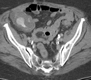 C:\Users\Ryan\Desktop\Desktop Data\Radiology\TEACHING FILES\Bowel\GI Bleed CT\CT\ser006img00058.jpg
