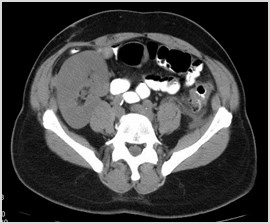 C:\Users\Ryan\Desktop\Desktop Data\Radiology\TEACHING FILES\Bowel\Diverticulitis\Axial with transplant kidney 3.jpg