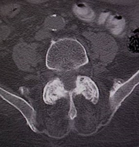 facet arthropathy