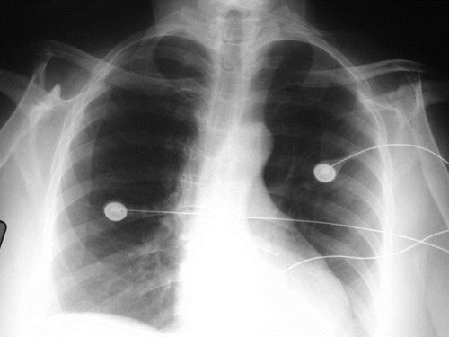 rheumatoid arthritis cxr with shoulder dz