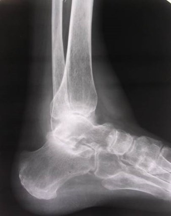 rheumaoid nodules ankle