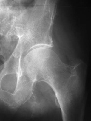 normal hip ap