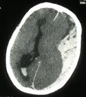 large acute SDH w IVH
