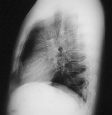 normal lateral cxr