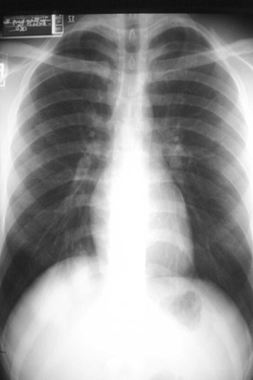 pneumonia behind diaph long PA