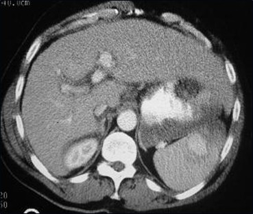 Splenic laceration w PSA-1