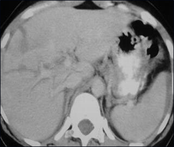 Liver laceration-01