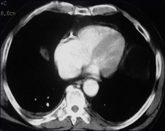 Multi-trauma-rib fx-1