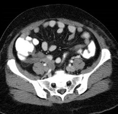 3 appy base cecum thick