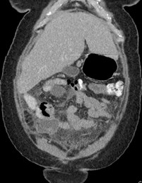 11-24-08 peritonitis, interloop abscesses.jpg