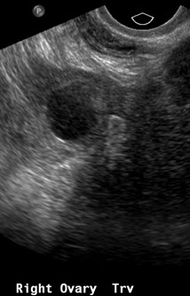 Nl ROV w cyst.jpg