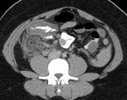 CT abn cecum.jpg