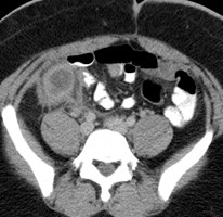 CT abscess.jpg