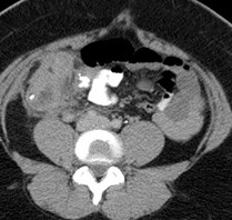 CT appendicolith.jpg