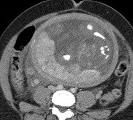 CT 2