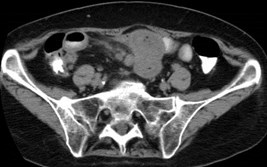 Morgan,Lorraine, carcinoid CT-4