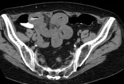 Morgan,Lorraine, carcinoid CT-2