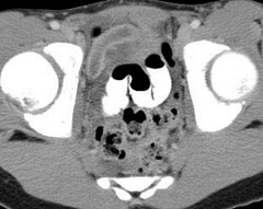 distal dilated appendix
