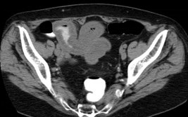 Morgan,Lorraine, carcinoid CT-3