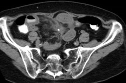 Morgan,Lorraine, carcinoid CT-1
