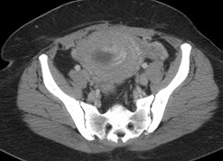 pregnancy CT.jpg