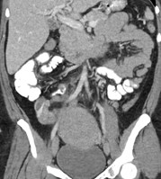 cor ROV thrombosis.jpg