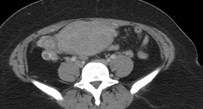 Rt ov w vein thrombosis.jpg