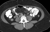Rt ov w vein thrombosis, appy.jpg
