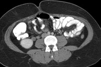 Rt ov w vein thrombosis, appy.2.jpg