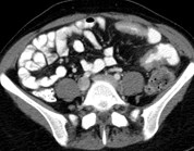 LLQ Crohn's.jpg